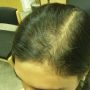 Маска для роста волос при алопеции